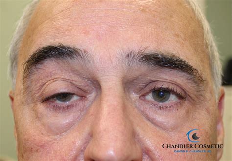 Ptosis Eyelift Man 1 Before - Chandler Cosmetic | Dr. Damon B. Chandler