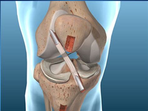 ACL Tears and Surgery - Physiotherapy Victoria BC