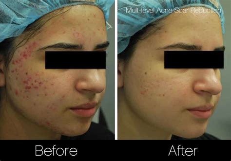 Blue Light Therapy For Acne Rosacea | Shelly Lighting