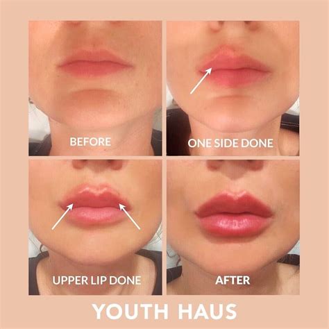 Juvederm Lips Before And After Half Syringe | Sitelip.org