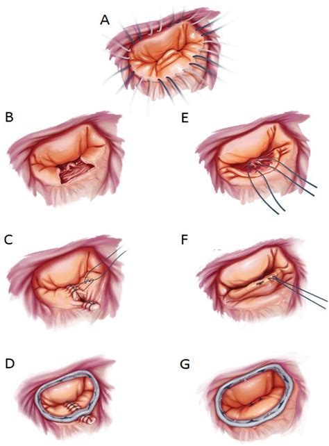 Randomised trial of mitral valve repair with leaflet resection versus ...