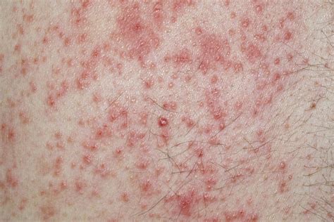 The Health Hub: Contact dermatitis - Overview