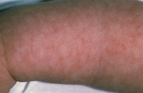 Common Skin Rashes Babies