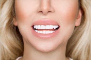 TruSmile Veneers Review: Are They Worth the Price? - Dentaly.org