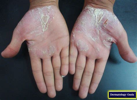 plantar dermatosis - pictures, photos