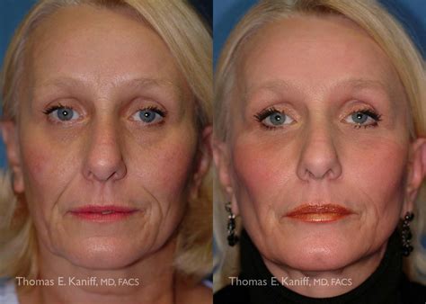 Mini Face Lift Facial Cosmetic Surgery Associates | Facial Cosmetic Surgery Associates