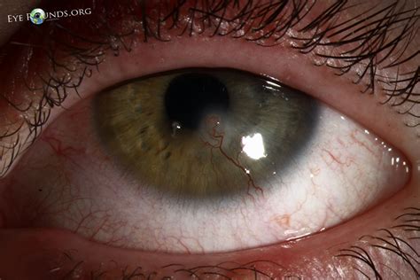 Atlas Entry - Blepharokeratoconjunctivitis of childhood