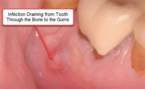 Does Draining A Dental Abscess Hurt - Best Drain Photos Primagem.Org