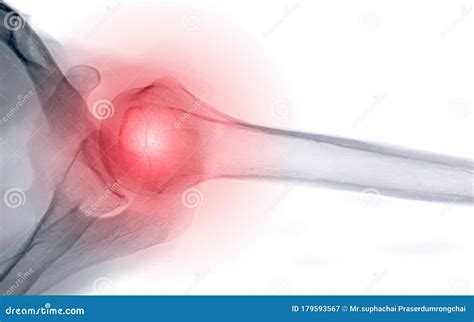 X-ray Shoulder Joint Shoulder Transaxillary View for Diagnosis Fracture of Shoulder Joint Stock ...