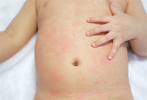 Treatments For Heat Rash In Babies | Woman and Girls