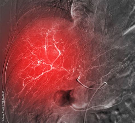 Imaging of TACE or Chemoembolization is a procedure that allows a dose of chemotherapy drugs to ...