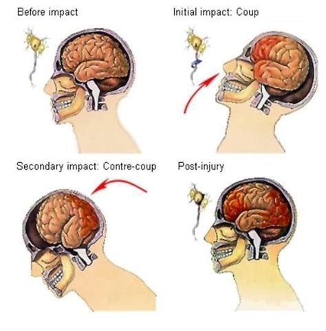 Second Impact Syndrome | Symptoms, treatment, recovery & stories in ...