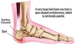 Heel Spur Surgery · 2022 Top Foot Doctor, Podiatrist in NYC