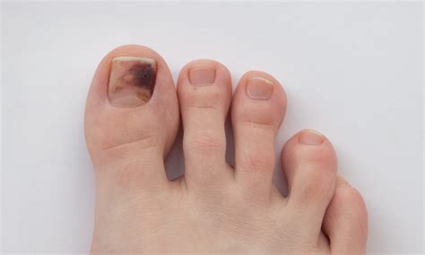 Melanoma under toenail pictures: black spot, nail melanoma pictures, toenail melanoma pictures ...