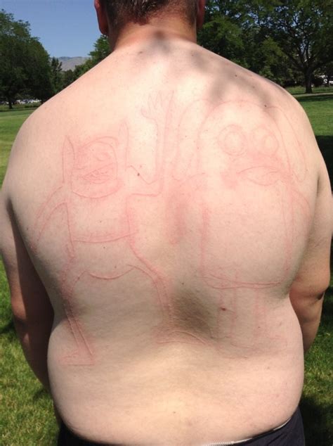 What happens when my friends find out that my skin welts up easily from scratches - Meme Guy