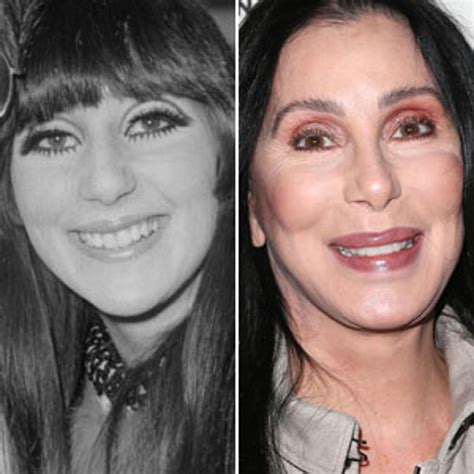 Cher Plastic Surgery Pictures