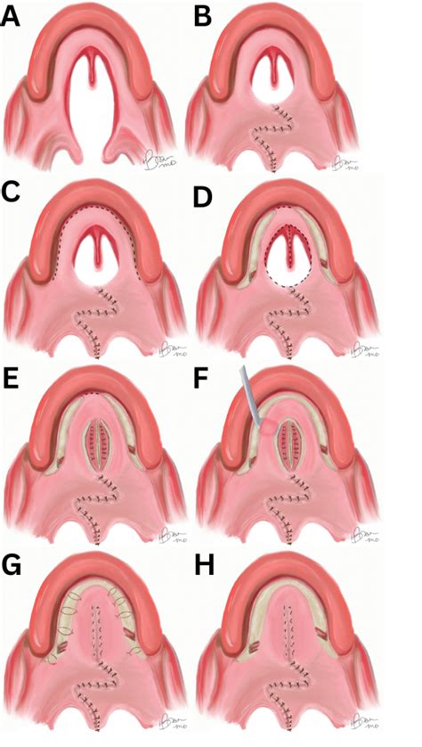 Bipedicled Palatoplasty For Closure Of Wide Veau Class II, 58% OFF