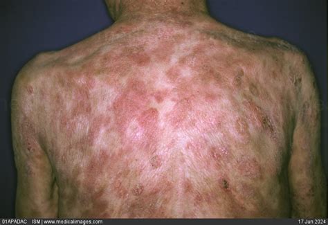 Mycosis Fungoides Rash