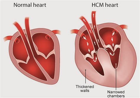 HCM (Hypertrophic Cardiomyopathy) in Cats - PDSA