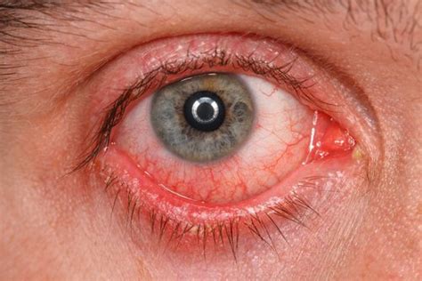 Chlamydial conjunctivitis vs. Gonococcal conjunctivitis Symptoms ...