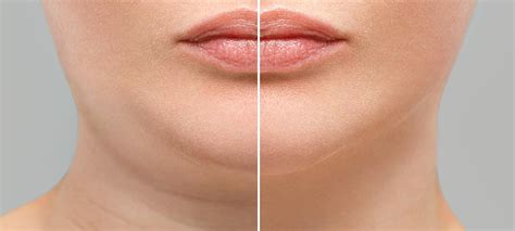 Botox for Sagging Jowls Before and After - SA