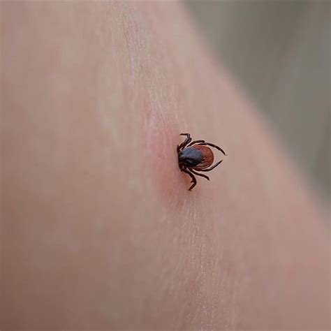 Formidable Tips About How To Get Rid Of A Tick - Assistancecorporation