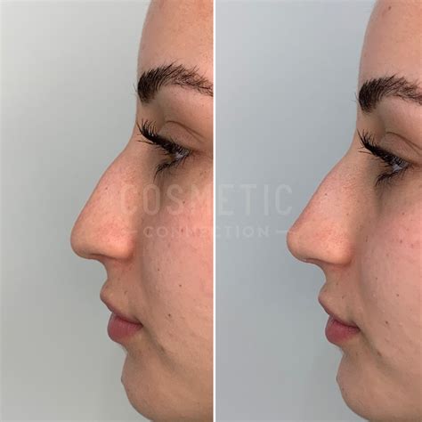 Nose Tip Plasty Filler - Cosmetic Connection