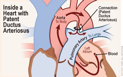 Patent Ductus Arteriosus (PDA) | Rady Children's Hospital