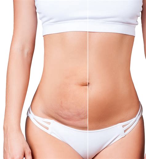 how to get a tummy tuck for free canada - Good It Webzine Photographic Exhibit