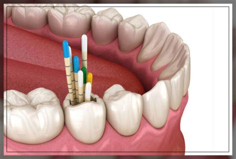 Dental Gutta-Percha: Use and Benefits - Engiomed