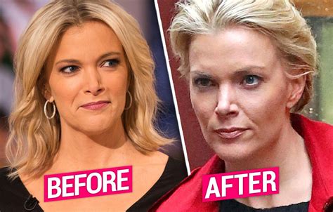 Megyn Kelly Nose Job