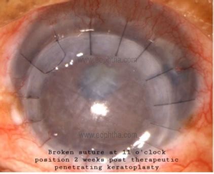 Complications of Penetrating Keratoplasty