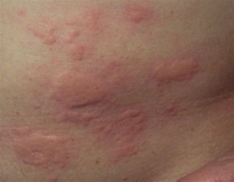 Roseola Rash - Pictures, Causes, Symptoms, Treatment