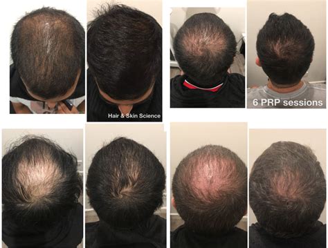 PRP Hair Loss Treatment | Sydney, Melbourne & Brisbane