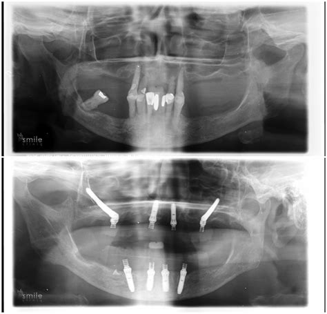 All On 4 Dental Implants In Our London Smile Clinic