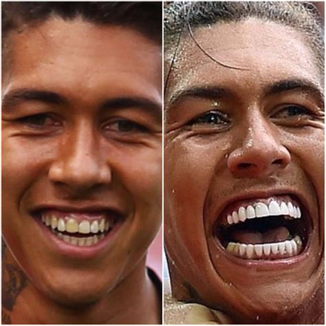 Jurgen Klopp Teeth Before And After - As Simon Cowell Shows Off Gleaming Teeth Other Celebs Who ...