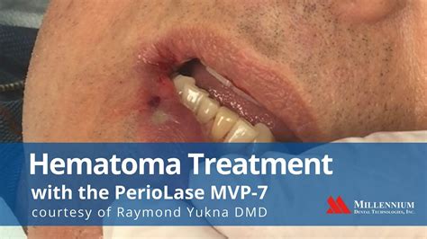 Hematoma Treatment with the PerioLase MVP-7 - YouTube