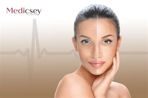 Laser skin rejuvenation in Turkey