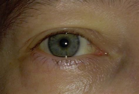 How To Get Rid Of Yellow Eyes Jaundice - TeethWalls