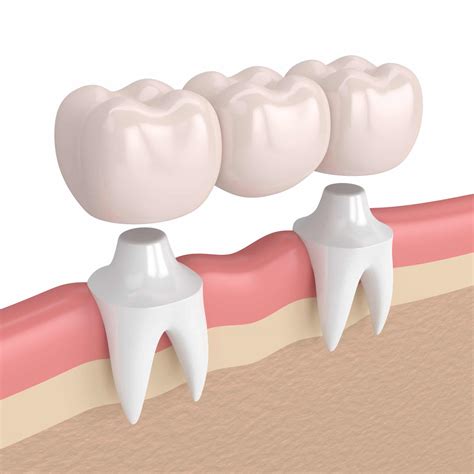 Astoria Dentist Explains How A Bridge Prevents Tooth Loss Complications ...