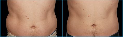 Coolsculpting Abdomen - Coolsculpting