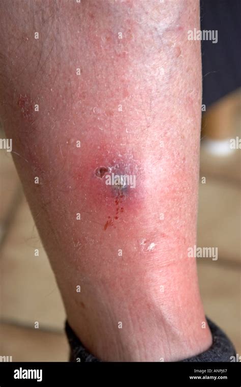 Septic leg wound and scab on shin of middle aged man Stock Photo - Alamy