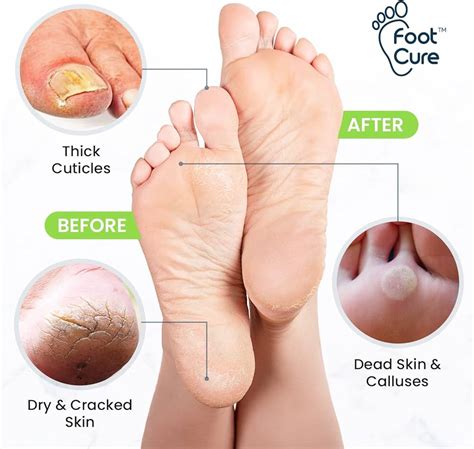 Painful Callus On Heel Of Foot Treatment Deals | emergencydentistry.com