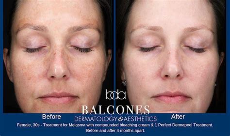 MELASMA Before & After Gallery - Austin, TX: Balcones Dermatology & Aesthetics