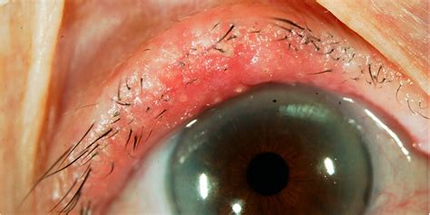 Skin Cancer On Upper Eyelid