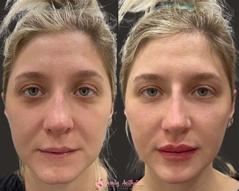 Juvederm Cheeks Before And After Photos