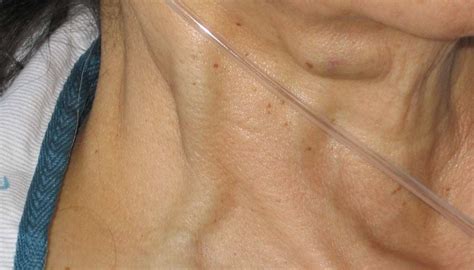 Jugular vein distention (JVD): Causes, risk factors, and diagnosis