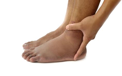 Pitting Edema VS Non-Pitting Edema: What’s the Difference? - Louisville ...