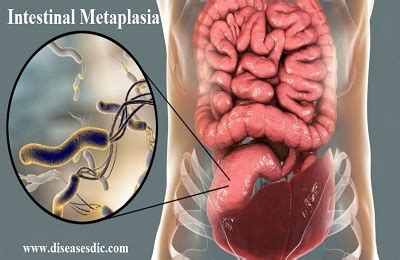 Intestinal Metaplasia – Causes, Risk Factors, and Prevention.