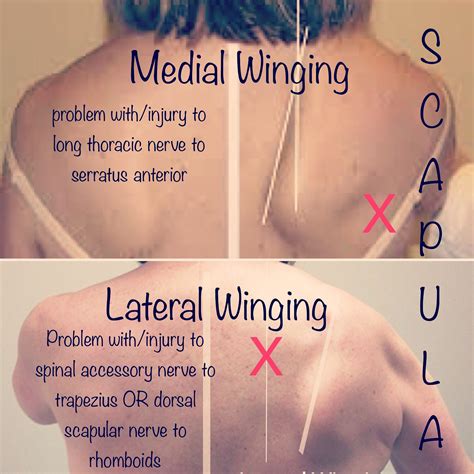 Anatomy Of Scapular Winging